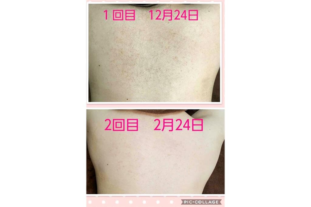 脱毛サロン Mimi 3