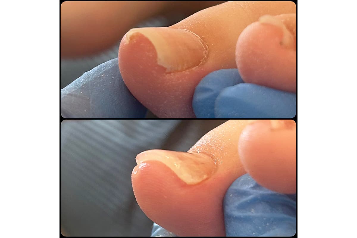 巻き爪ケア補正サロン 3ml 4