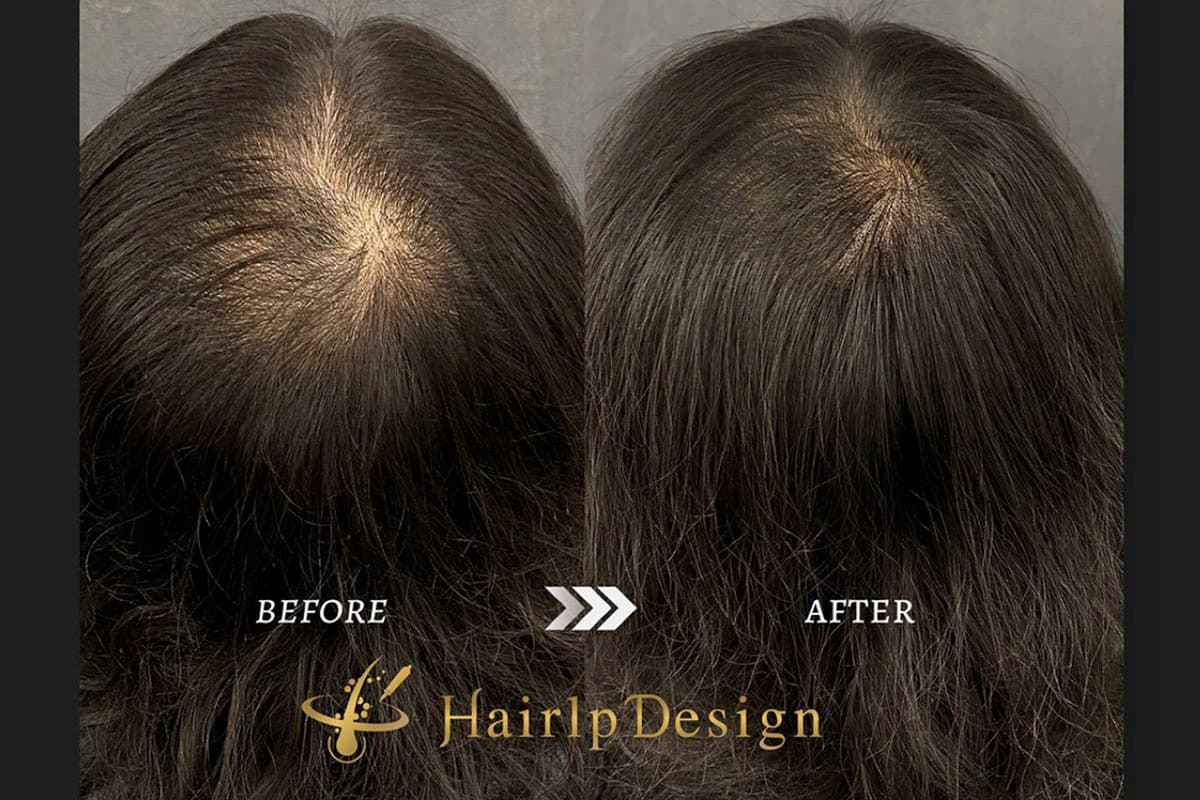 薄毛を改善!! Scalp Design HAIR TATTOO 甲府昭和店 【休業】 5