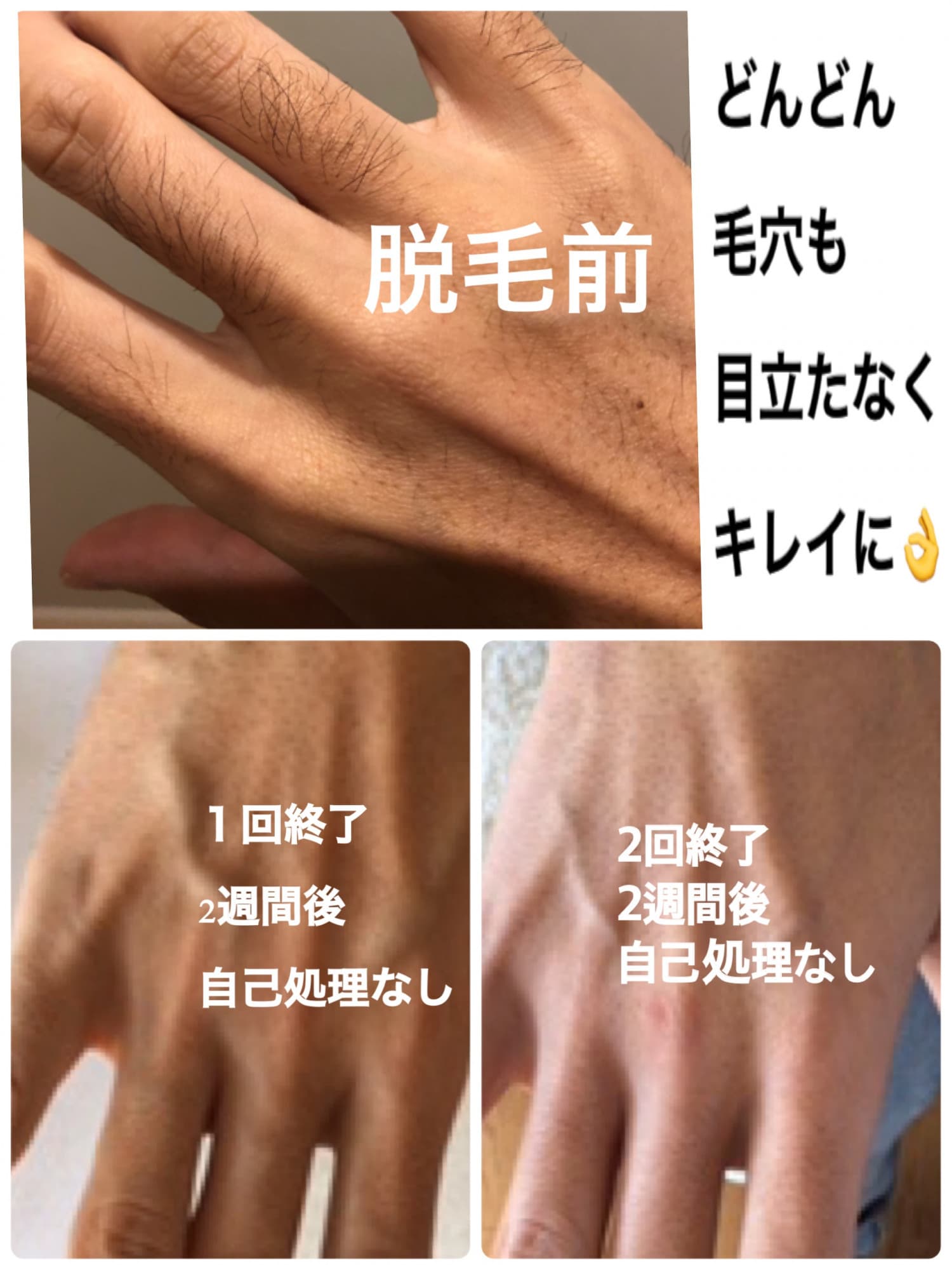 2週間毎に脱毛できる🎀