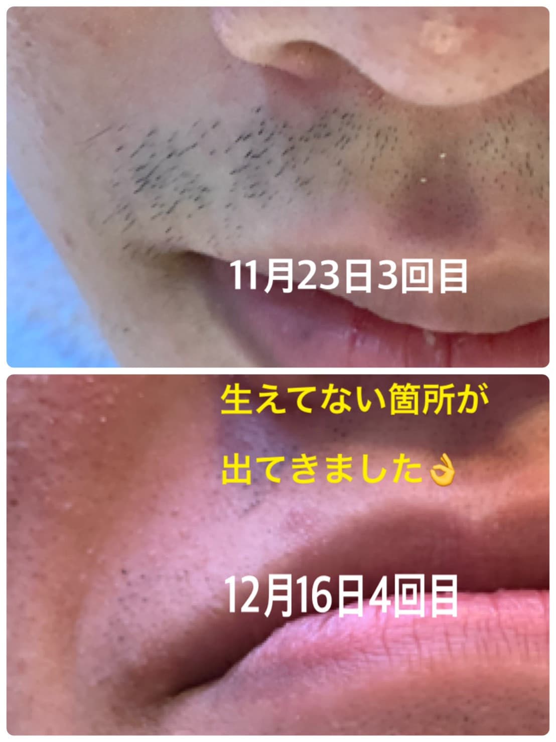 痛みの少ないヒゲ脱毛✨